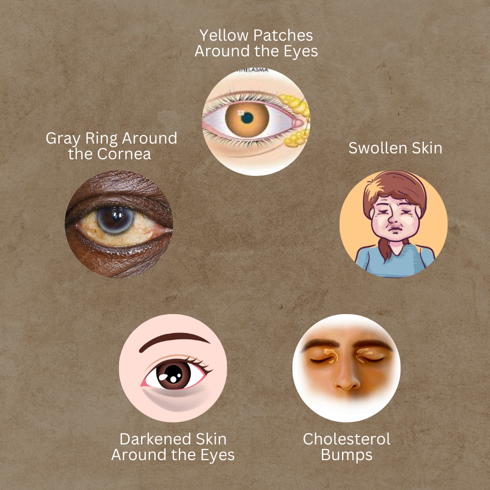 Common Signs of High Cholesterol on the Face